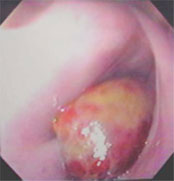 Endoscopy